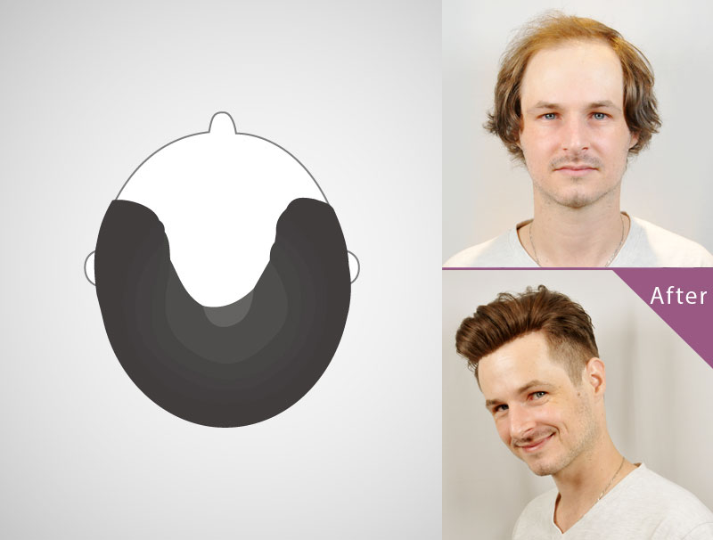 U-shaped hair loss